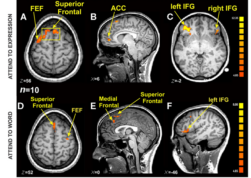 fMRI Brain Activation Example